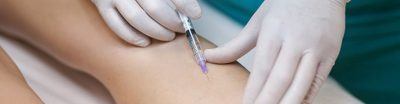 Склеротерапия ретикулярных вен и сосудистых звездочек