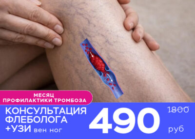 Варикоз и тромбоз: как не пропустить тревожные сигналы